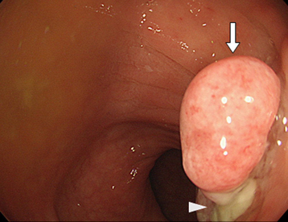 Lower endoscopy revealed a 10-mm tumor in the rectosigmoid colon (white arrow), surrounded by a white coat (white arrowhead).
