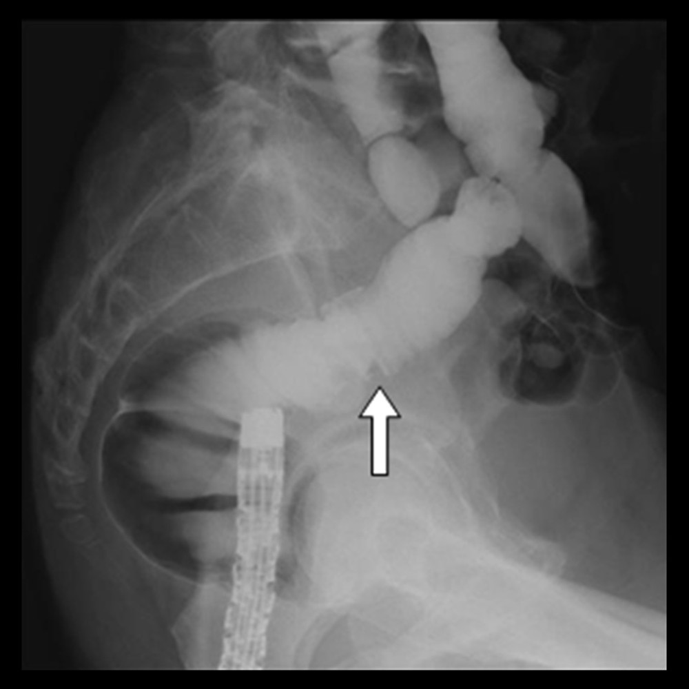 Enema gastrographic imaging in lateral view showed missing images of the 10-mm tumor in rectosigmoid colon (white arrow), but no appearance of a fistula or an extra-contrast agent.