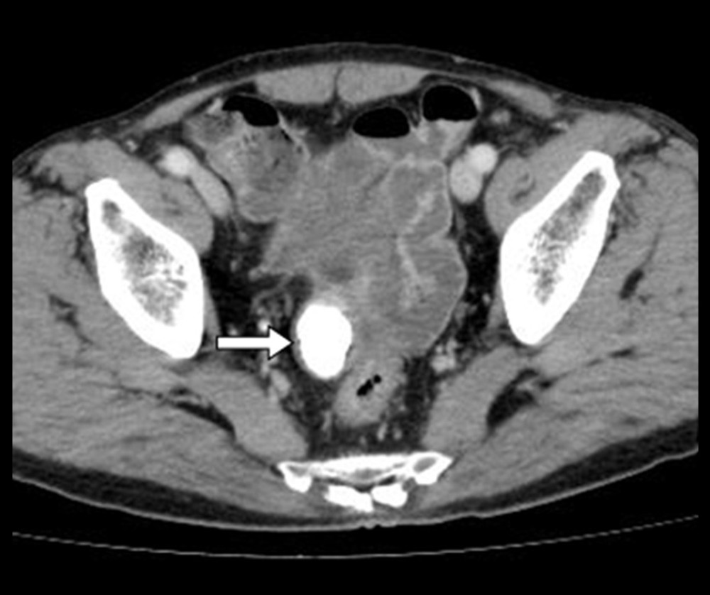 Contrast CT showed no appearance of the tumor or swelling of the rectum lymph nodes and a huge feces stone in the appendix apex with liquid storage (white arrow).