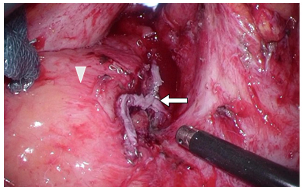 Laparoscopic appearance showed difficulty in resection of the adhesion between the appendix and rectum; thus, a wedge-shaped resection was conducted at the rectosigmoid colon (white arrow; resection site, white arrow head; rectosigmoid colon wall).