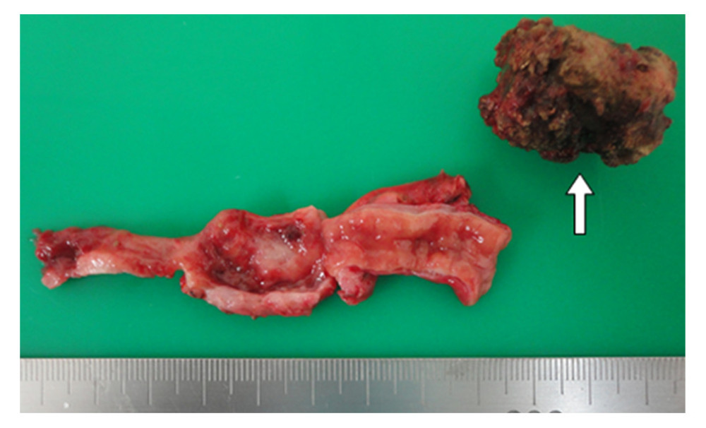 Extracted, opened specimens. There was a fecalith in the tip of the appendix (white arrow).