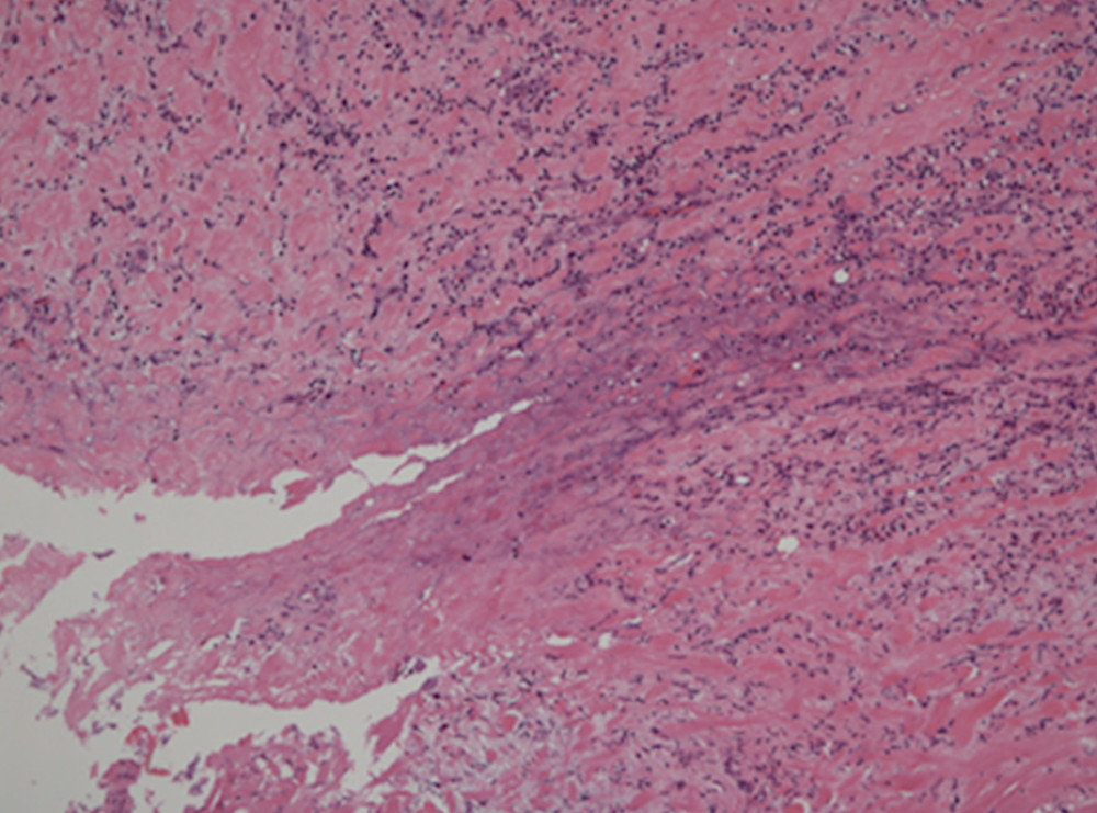 Permanent pathological examination showed phlegmonous appendicitis and spread of inflammation to the deep appendix and rectum wall, with no malignant appearance. (Hematoxylin and eosin staining: ×100).