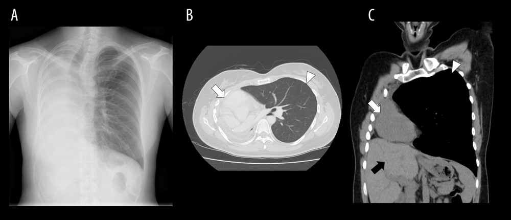 Chest images after pneumonectomy. Chest radiographs show the mediastinum shifting into the right pleural space (A). Chest computed tomography images on axial views (B) and coronal views (C). The left lung is overinflated (arrow) and the heart is shifted into the right space (white arrow). The hemidiaphragm and the liver are elevated (black arrow).