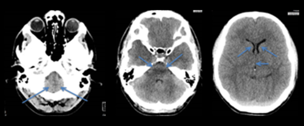 Axial non-contrast CT images showing sagging of the cerebellar tonsils into the foramen magnum, attenuation of the basal ventricles, and small lateral ventricles.