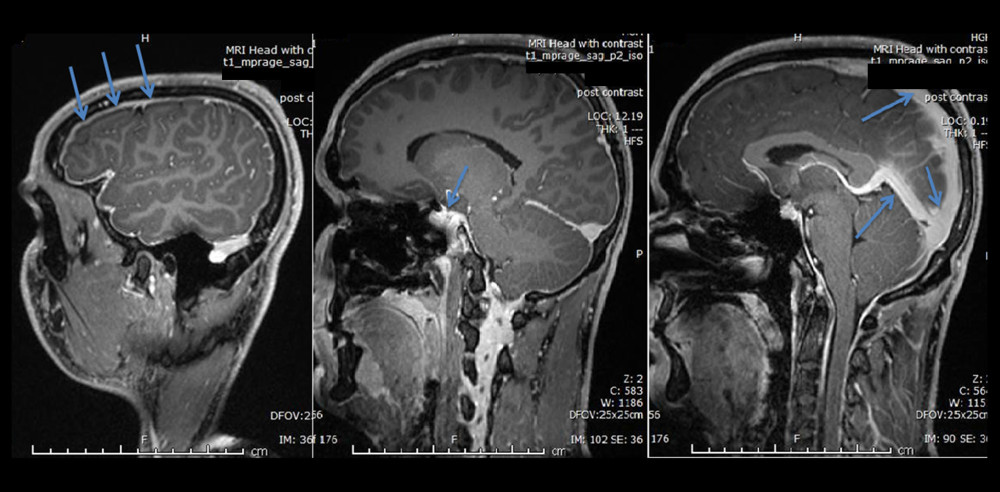 Sagittal MR images after intravenous injection of gadolinium, showing diffuse enhancement of the pachymeninges bilaterally, engorgement of the dural venous sinuses, hyperemia of the pituitary gland, and herniation of cerebellar tonsils.