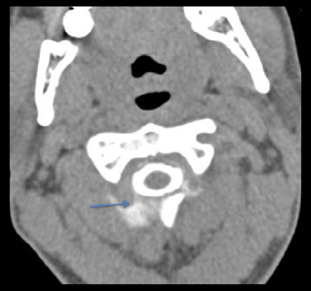 CT myelogram showing contrast fluid oozing posterolaterally on the right side, indicating the location of CSF leakage.
