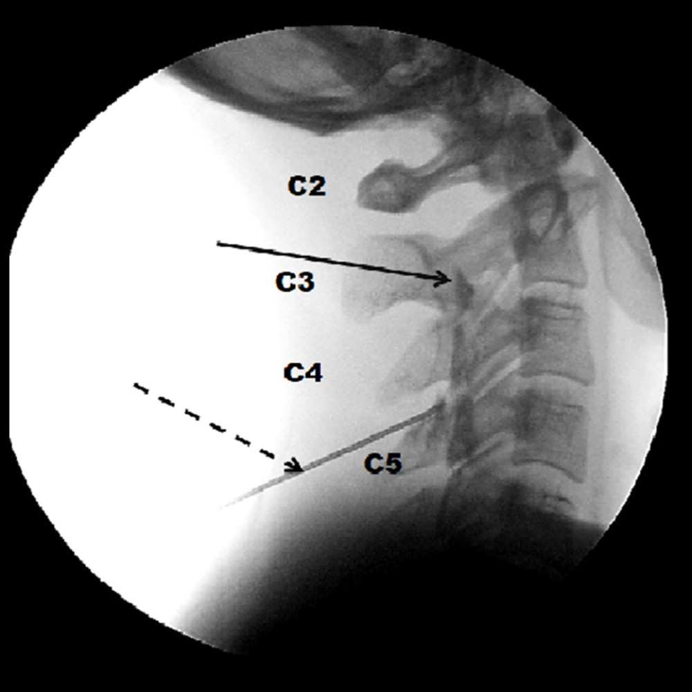 Contrast in epidural space (solid arrow) and the 18-gauge Tuohy needle (dotted arrow).
