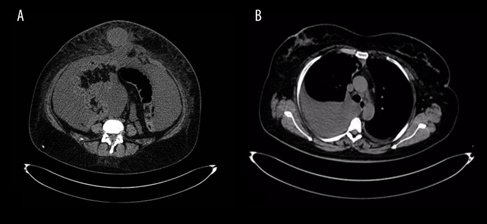 Computed tomography (CT) scans at the start of treatment. (A) Abdominal CT scan showing carcinomatosis. (B) Thoracic CT scan showing pleural effusion.