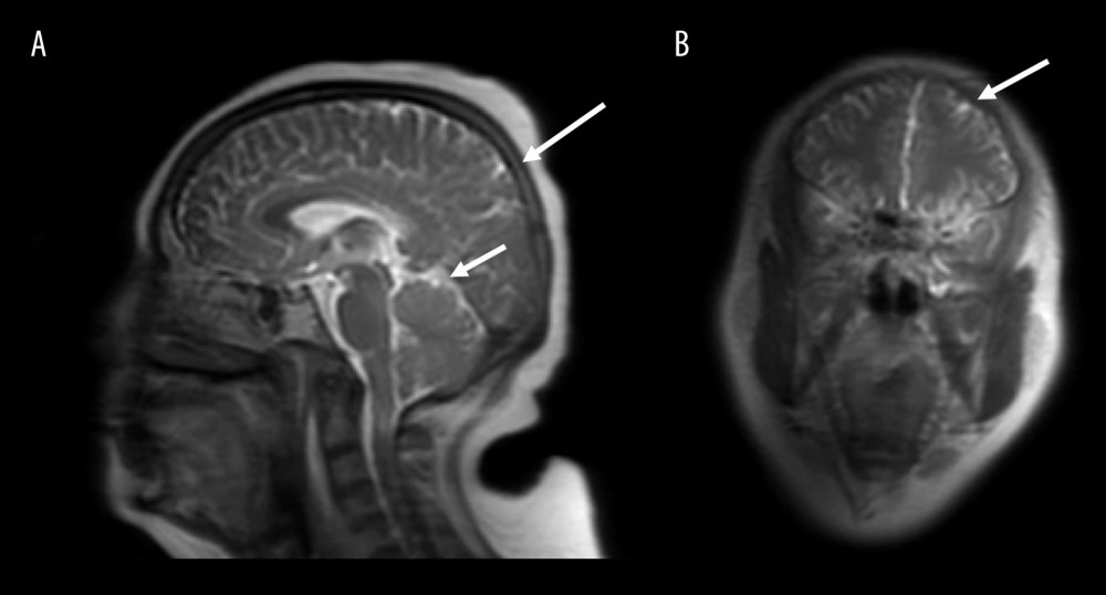 Magnetic resonance imaging of the head 23 months after the first visit (A: Midline plane; B: Coronal plane). The arrows point to metastatic lesions.