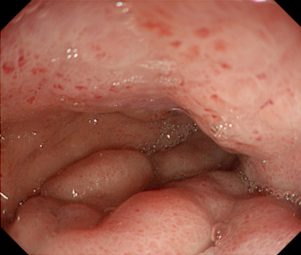 Upper endoscopy revealing the appearance of loss of distensibility and superficial gastritis of the entire stomach. There was no obvious cancer lesion(s) within the observation field.