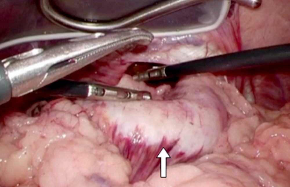 After towing the stomach into the abdominal cavity, induration of the entire stomach was confirmed with forceps (white arrow).