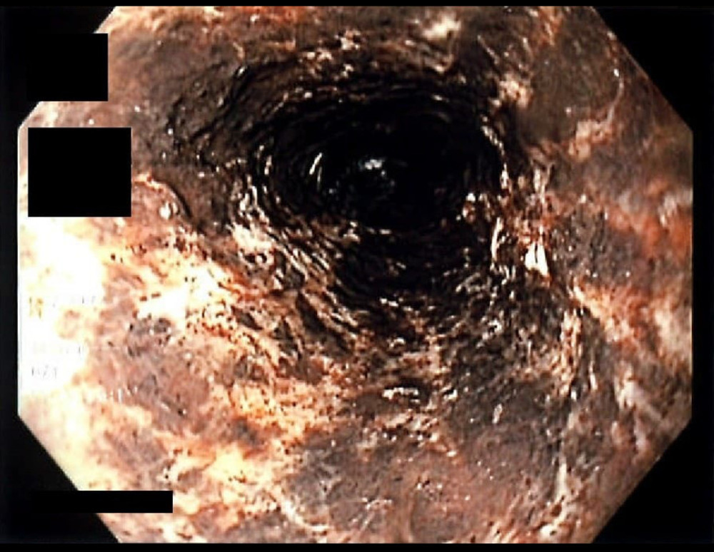Esophagogastroduodenoscopy (EGD) exposing a necrotic esophageal mucosa.