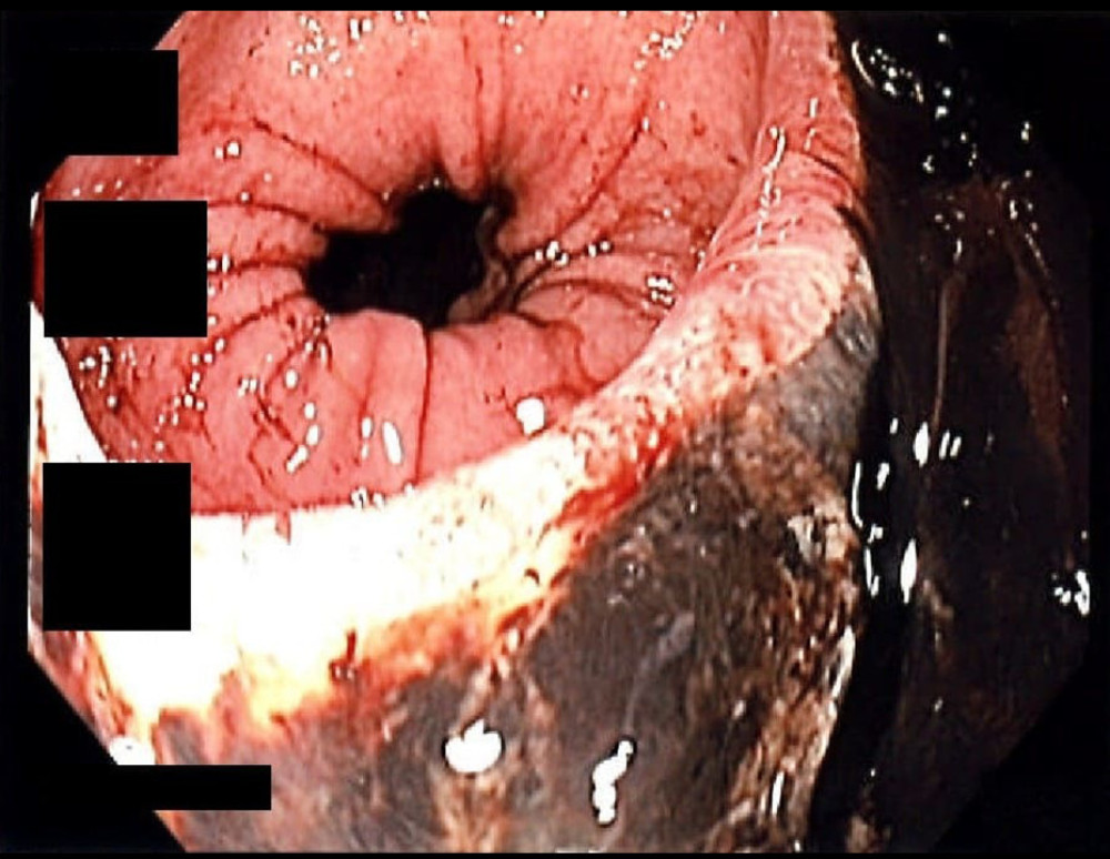 Esophagogastroduodenoscopy (EGD) showing a sharp demarcation at the gastroesophageal junction (GEJ).