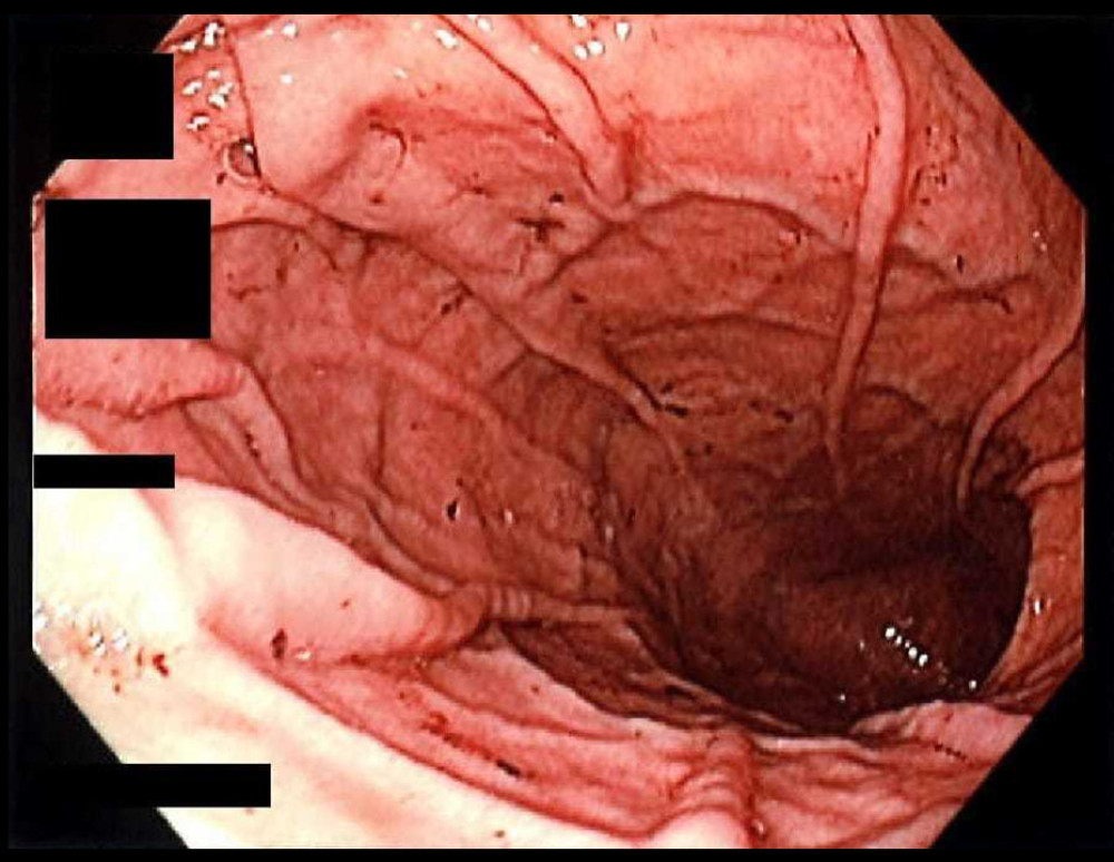 Esophagogastroduodenoscopy (EGD) revealing the gastric mucosa with erosions.