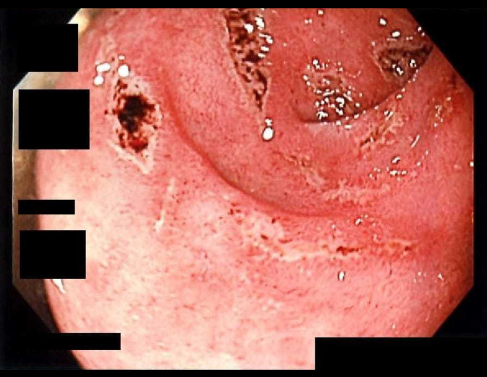 Esophagogastroduodenoscopy (EGD) revealing proximal duodenal ulcerations.