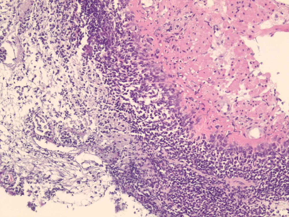 Histologic appearance of acute esophageal necrosis or black esophagus: hematoxylin and eosin (H&E) staining showing necrotic debris, absence of epithelium, granulation tissue, and robust leukocyte infiltrates at 100× magnification.