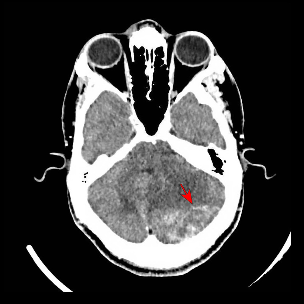 CT scan head (red arrow: ring-enhancing lesion (post-contrast images) seen in left the cerebellar folia measuring approximately 3.6×3.0 cm close to the left tentorium, with marked surrounding edema causing effacement of the fourth ventricle, pons, and part of the midbrain.