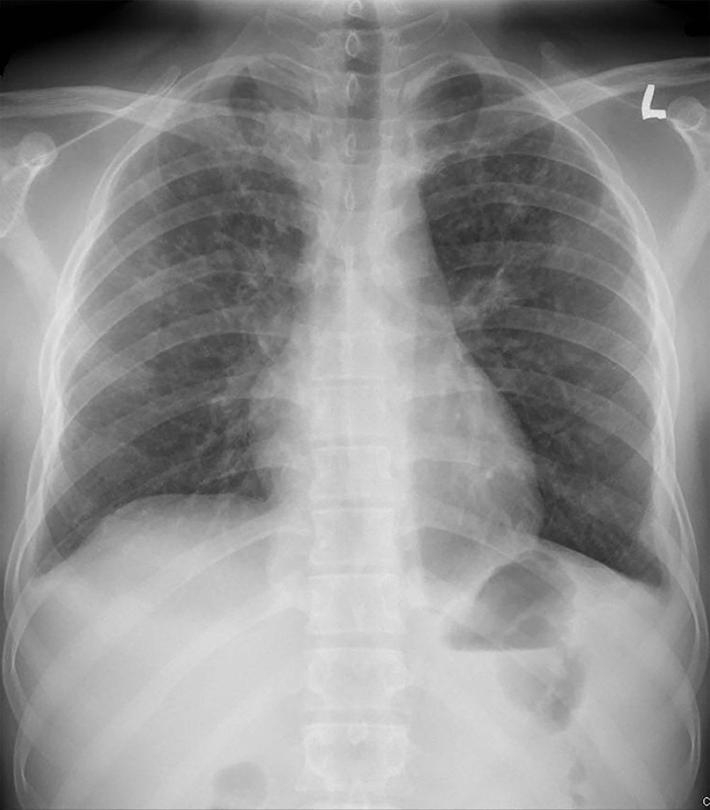 Chest X-ray showing bilateral infiltrates, mainly in the upper zones.