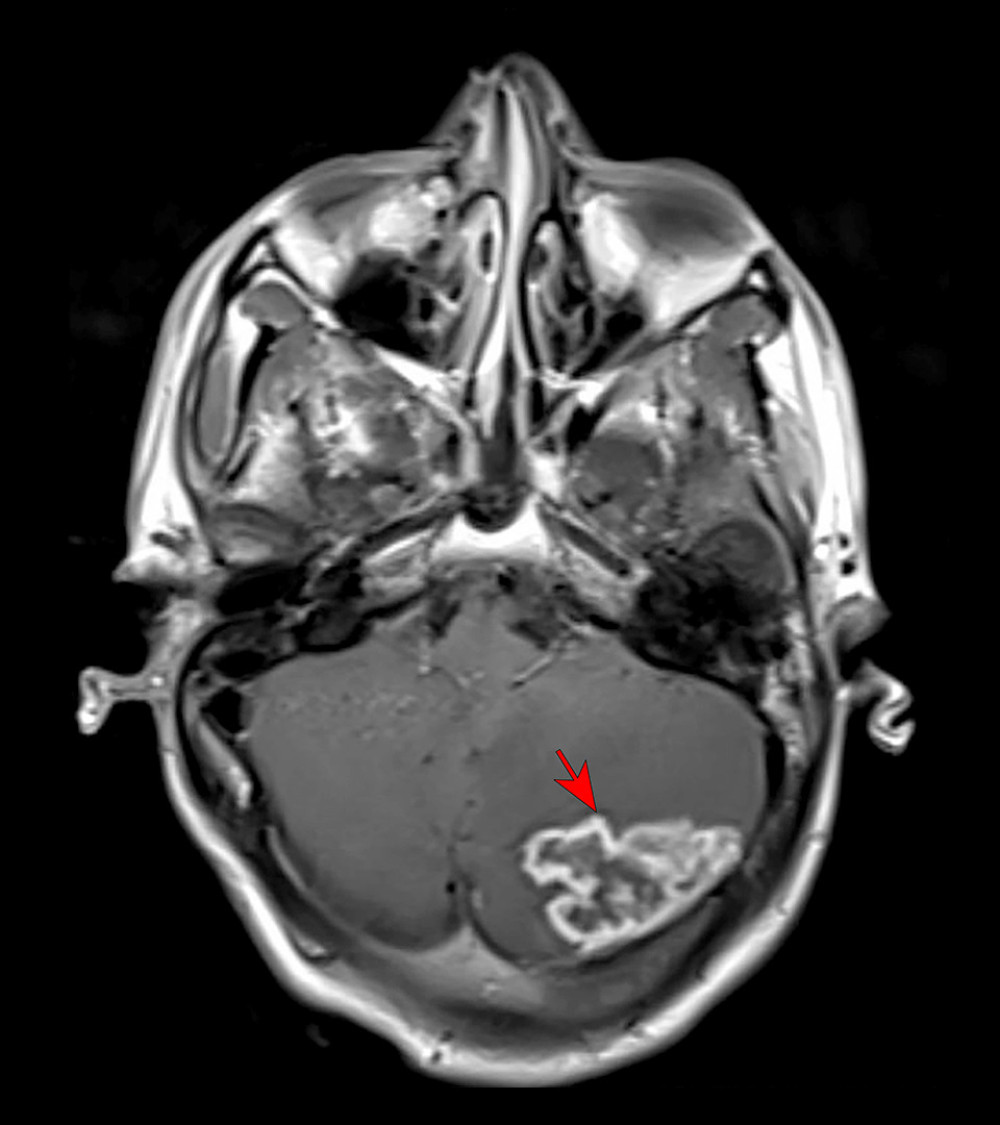 MRI head (red arrow: irregular intra-axial mass (3×4×2.7 cm) in the posterosuperior aspect of the left cerebellar hemisphere abutting the inferior surface of the left tentorial leaflet.