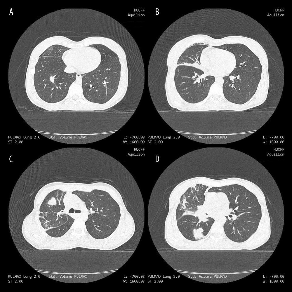 CT scan of the chest with a lung window showing a spiculated 15×11 mm nodule in the lower lobe of the right lung (A), pleural thickening in the region of the interlobar fissure (B). Two soft-tissue density nodules in the right upper lobe (C) and in the right lower lobes (D), in addition to a lobed contour mass involving bronchovascular structures of the right pulmonary hilum and causing partial obstruction of the right middle bronchus and ground-glass infiltration in the middle lobe (D).