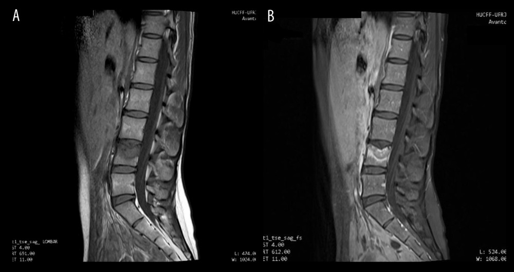 Magnetic resonance imaging of the lumbar spine showing reduced height of the L4 vertebral body with hyposignal area in T1 (A) and with heterogeneous contrast enhancement (B) in the upper plateau of L4 with an associated Schmörl node, suggesting a metastatic implant, probably responsible for the patient’s lumbar spine pain.