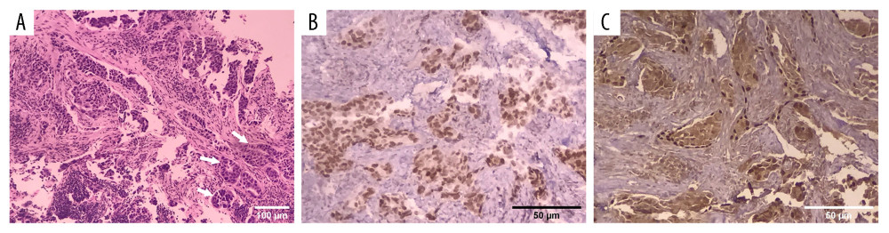 Histological aspect of the lesion biopsy showing infiltrating nests with a carcinomatous characteristic with poorly differentiated glandular structures in the lower right corner (A) Immunohistochemistry with TTF-1 labeling showing diffuse positivity in neoplastic cells (B) and p63 labeling with nuclear positivity in about 10% of neoplastic cells (C), indicating immunophenotype of double glandular and squamous differentiation, compatible with a diagnosis of ASC.