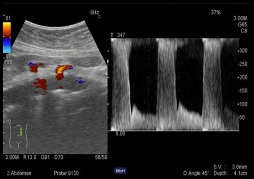 Preoperative Doppler ultrasound showing significant stenosis of the superior mesenteric artery with >3 m/s increase in PSV and no flow in the celiac trunk.