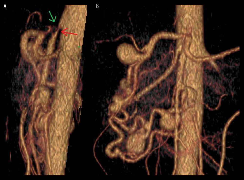 (A, B) 3D reconstruction of computed tomography angiography showing complete occlusion of the celiac artery (green arrow – A) and accompanying stenosis of the superior mesenteric artery (red arrow – A) caused by the median arcuate ligament, and multiple aneurysms in the collateral circulation: a 17-mm gastroduodenal artery aneurysm, a 13-mm superior pancreatoduodenal artery aneurysm, and an 11-mm aneurysm of the inferior pancreatoduodenal artery.