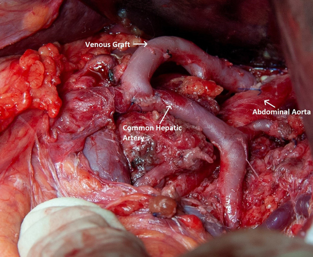Intraoperative image of aorto-hepatic venous bypass between the aorta (superiorly to the coeliac artery, end-to-side anastomosis) and common hepatic artery (end-to-side anastomosis).