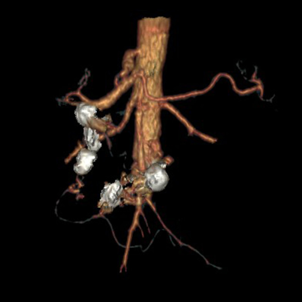 3D reconstruction of computed tomography angiography 48 months after treatment, showing patent aorto-hepatic graft, mesenteric arteries, and successfully embolized aneurysms.
