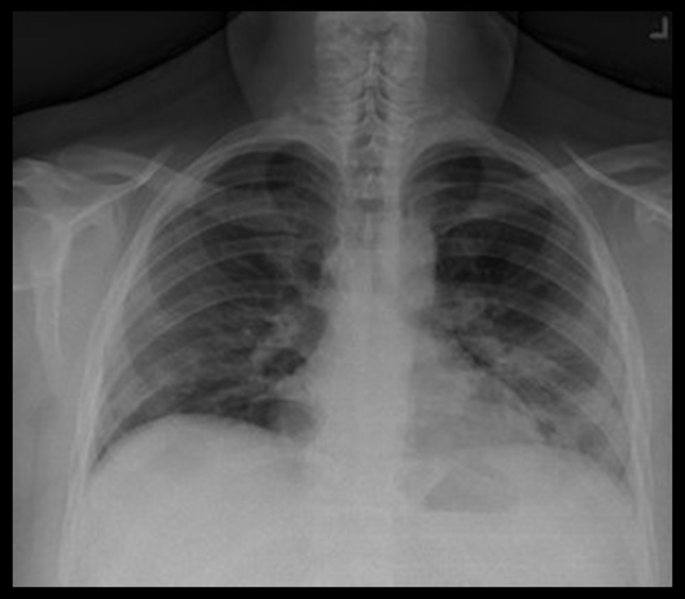 Chest X-ray showing peripheral patchy opacities in the lower lung zones.