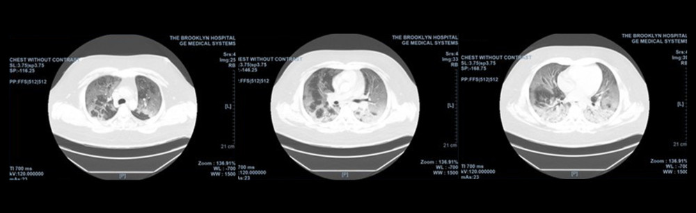 Chest computed tomography (CT) scan without contrast showing extensive bilateral ground-glass opacities with areas of confluent consolidation in the posterior lung bases.
