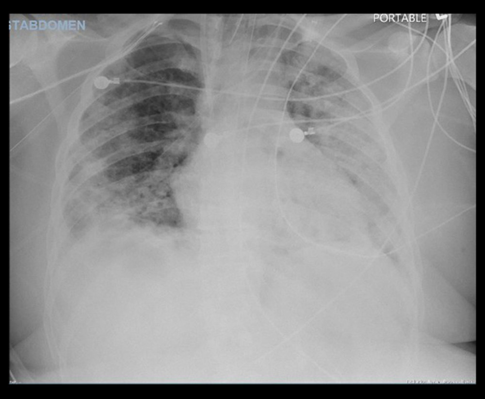 Repeated chest X-ray during recurrent episode of respiratory failure showing worsening opacities.