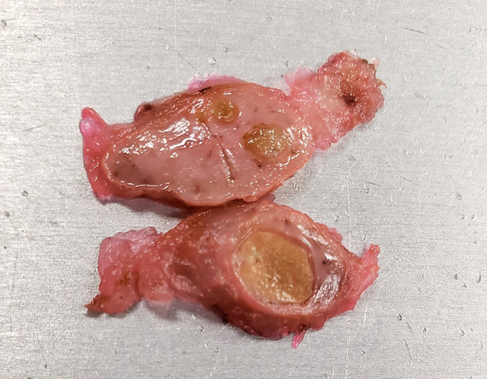 Two sentinel lymph nodes demonstrating multiple cysts filled with yellow “caseous” material.