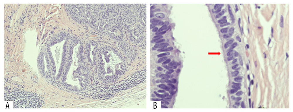 The glandular-type epithelial inclusions with large round tubular and papillary-shaped glandular structures (A). On high magnification, the epithelial cells have a Müllerian appearance with microvilli (arrow) (B).