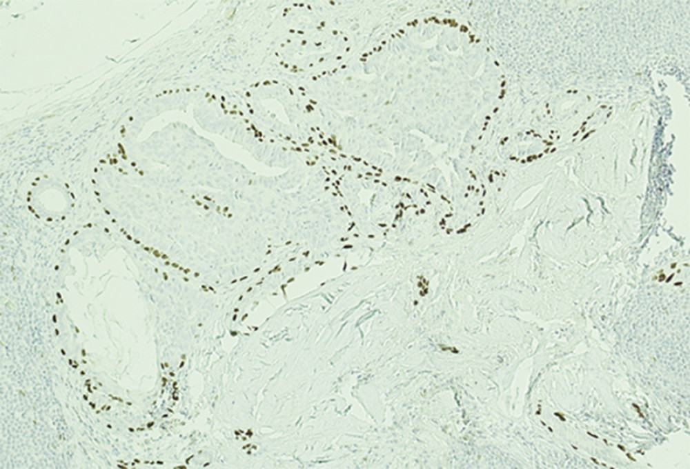 P63 immunostains highlighting myoepithelial cells present in the glandular-type epithelial inclusion cyst.