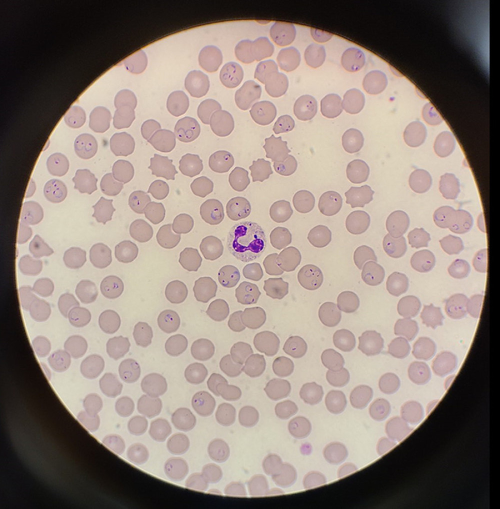 Numerous malaria organisms are present, affecting approximately 25% of red blood cells. Ring forms/ trophozoites have 1 or 2 chromatin dots. Multiply-infected red cells are not uncommon (2–4 trophozoites). A few elongated structures suggestive of developing gametocytes are seen.