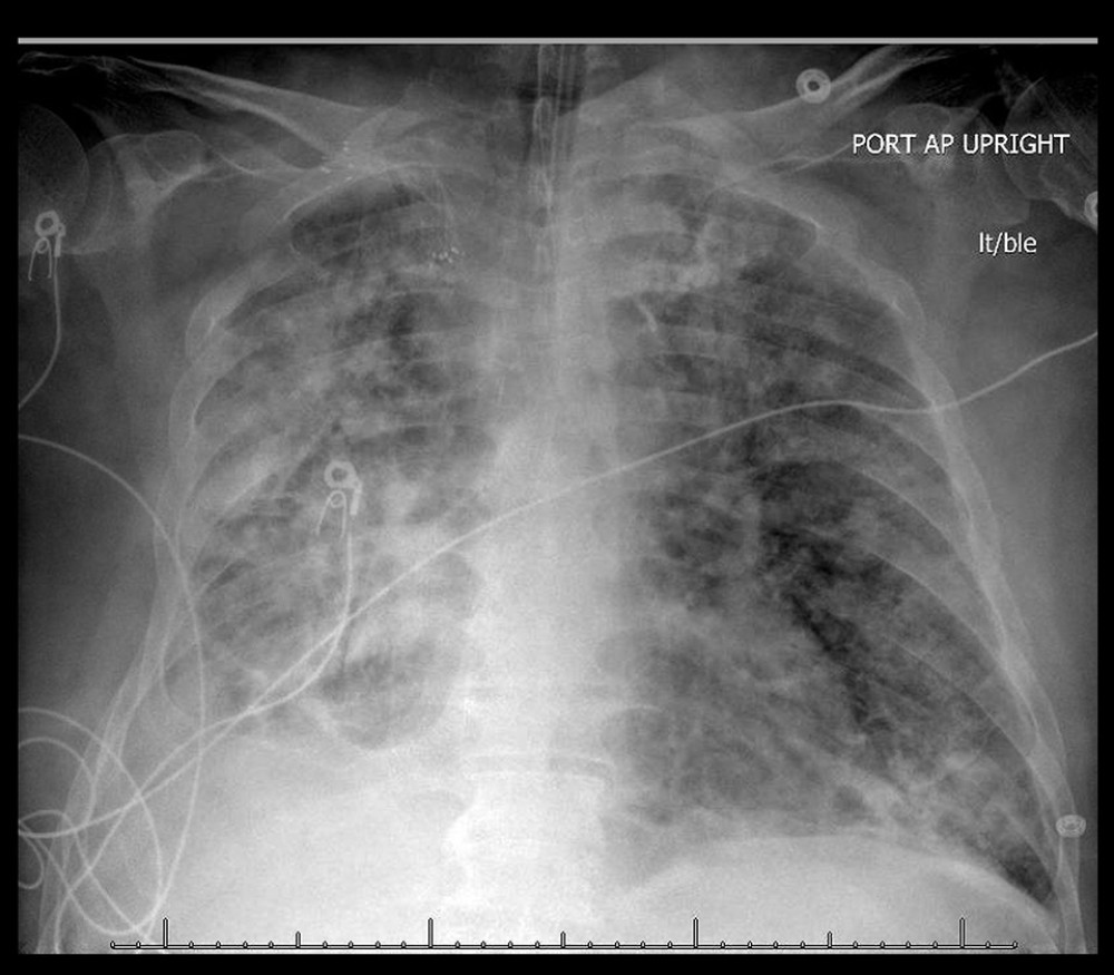 Chest X-ray showing multifocal pneumonia.
