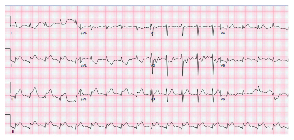 Electrocardiogram with ST-segment elevations in leads II and III and aVF with a reciprocal ST-segment depression in I, aVL, V5, and V6.