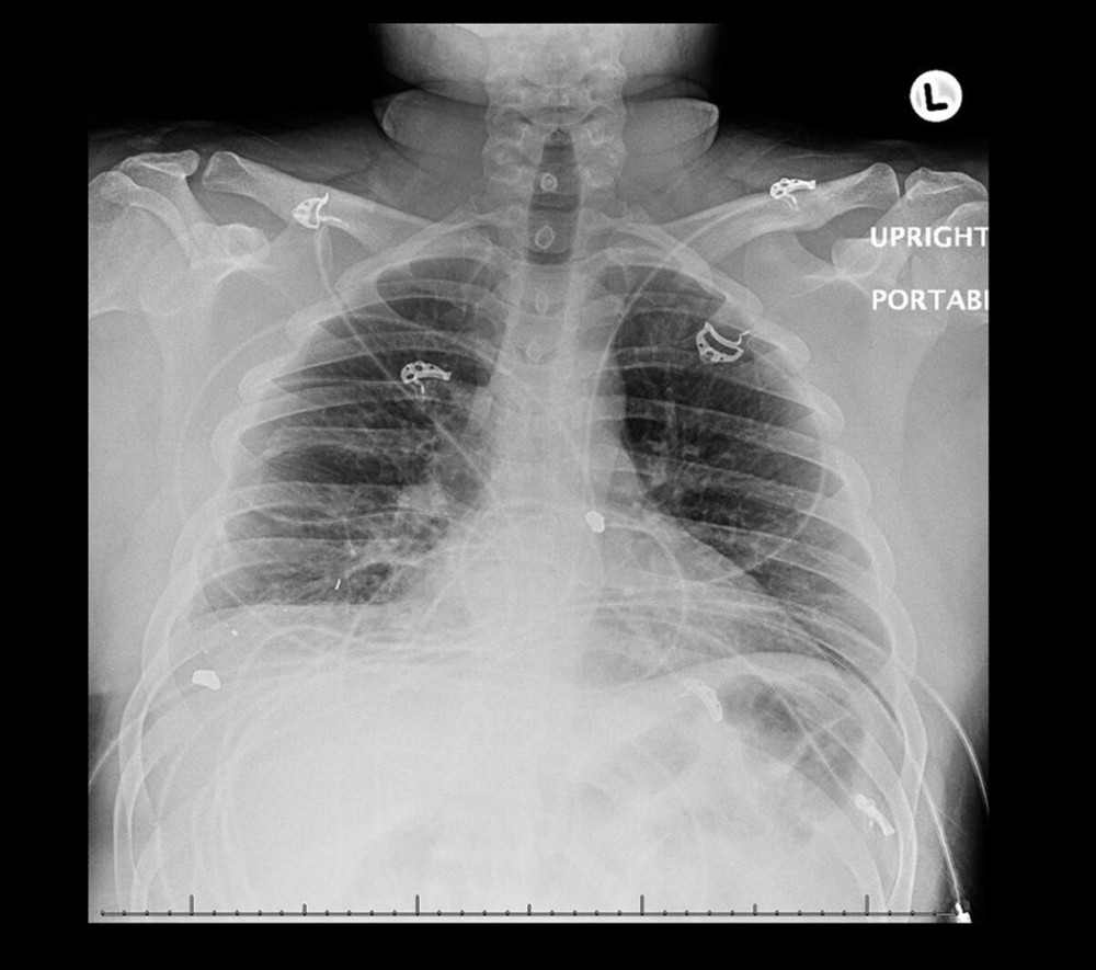 Chest radiograph revealing mild bilateral interstitial changes consistent with CARDS Type L on day 1.