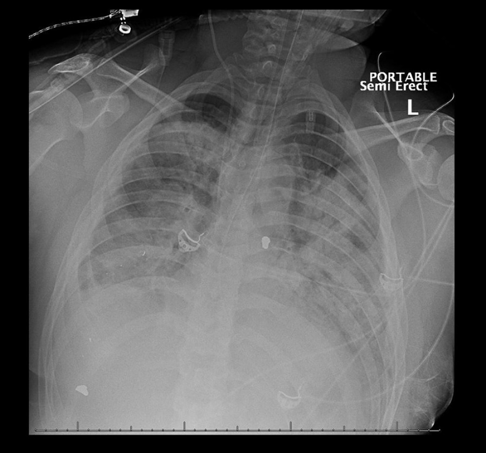 Chest radiograph revealing extensive bilateral consolidations consistent with CARDS Type H on day 8.