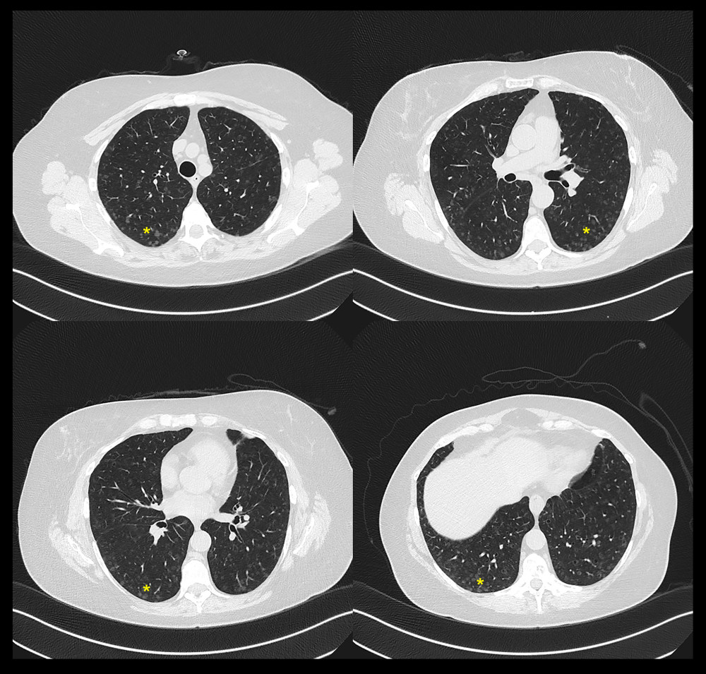 High-resolution chest computed tomography showing innumerable diffuse small ground-glass nodules (asterisks), some of which demonstrate central cavitation.