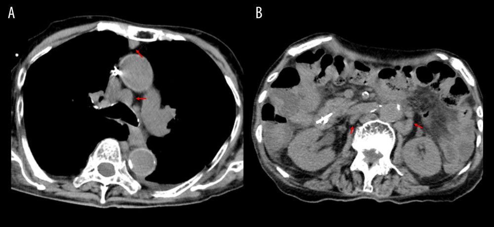 (A) Simple computed tomography image showing swollen lymph nodes, up to 2 cm in size, in the anterior mediastinum and pretracheal area (red arrows). (B) The computed tomography image showing swollen lymph nodes, approximately 2 cm in size, in the paraaortic area (red arrows).