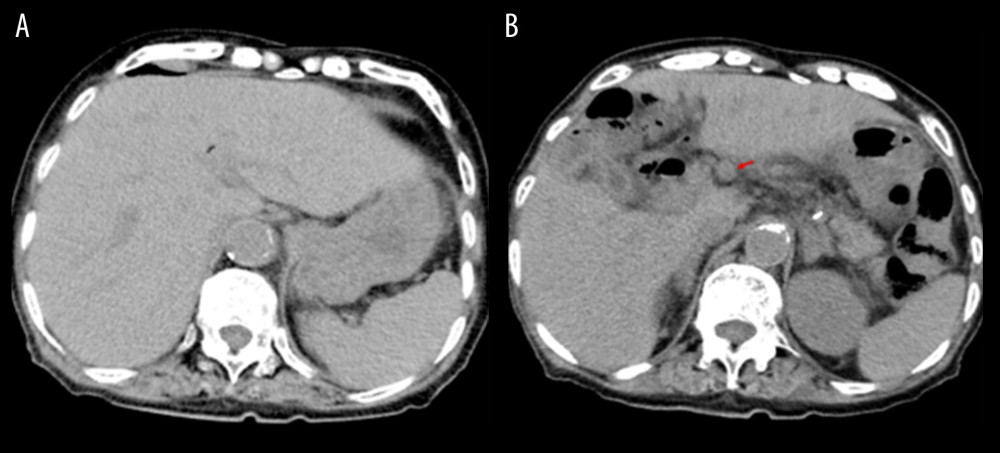 (A, B) Computed tomography imaging did not clearly show any intrahepatic lesions. However, a 2-cm swollen lymph node is visible in the hepatic hilum (B, red arrow).