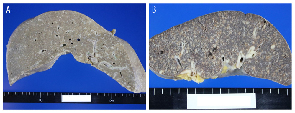 (A) A cut section of the liver with many nodules that were a few millimeters in size. Some nodules had evident distribution along the portal tracts. (B) A cut section of the spleen revealed numerous nodules that were up to 5 mm in size.