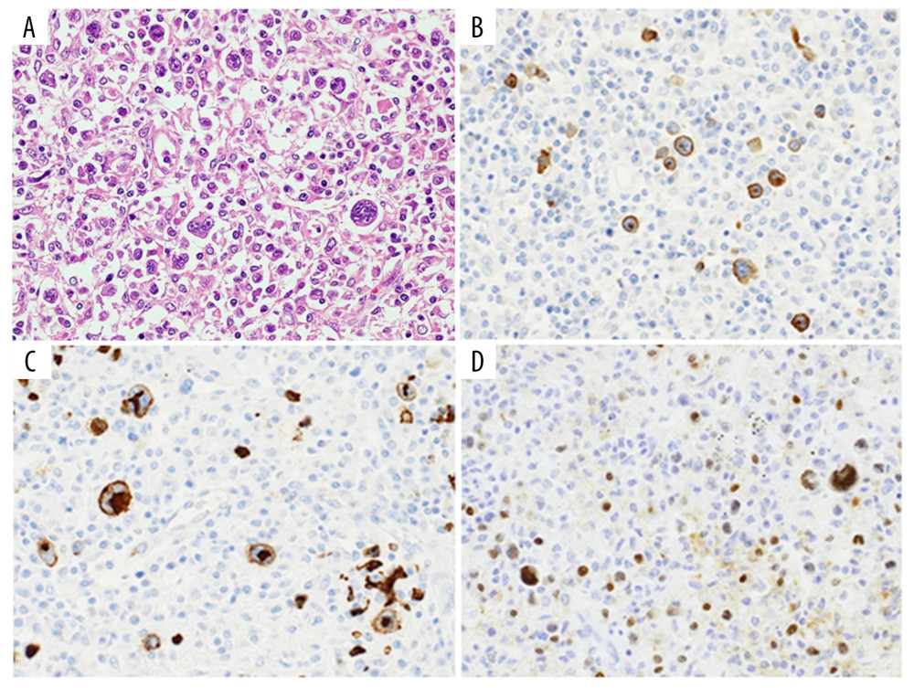 (A) Atypical large cells with a single nucleus or multiple nuclei were seen and were densely admixed with small lymphocytes, plasma cells, and macrophages in the tumor microenvironment. Hematoxylin and eosin stain; magnification, ×400. (B–D) The tumor cells (Hodgkin and Reed/Sternberg cells) were positive for CD30 (B), CD15 (C), and Mum1 (D). Magnification, ×400.