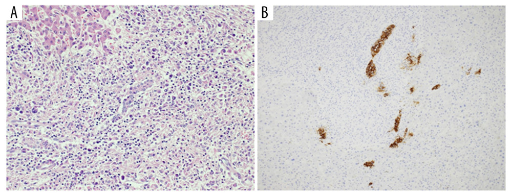 (A) Many inflammatory cells and several Hodgkin and Reed/Sternberg cells mainly infiltrated the portal tracts, with moderate distortion of the bile ducts and the neighboring hepatic cords. Magnification, ×200. (B) Immunohistochemistry demonstrated positivity of bile ducts for CD19-9. Magnification, ×200.
