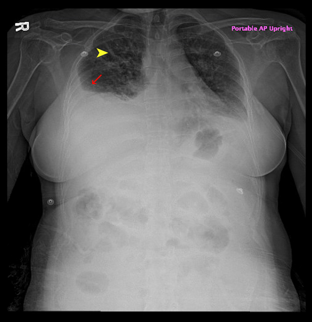 X-ray of the chest revealing pulmonary edema (yellow arrow) and pleural effusion (red arrow).