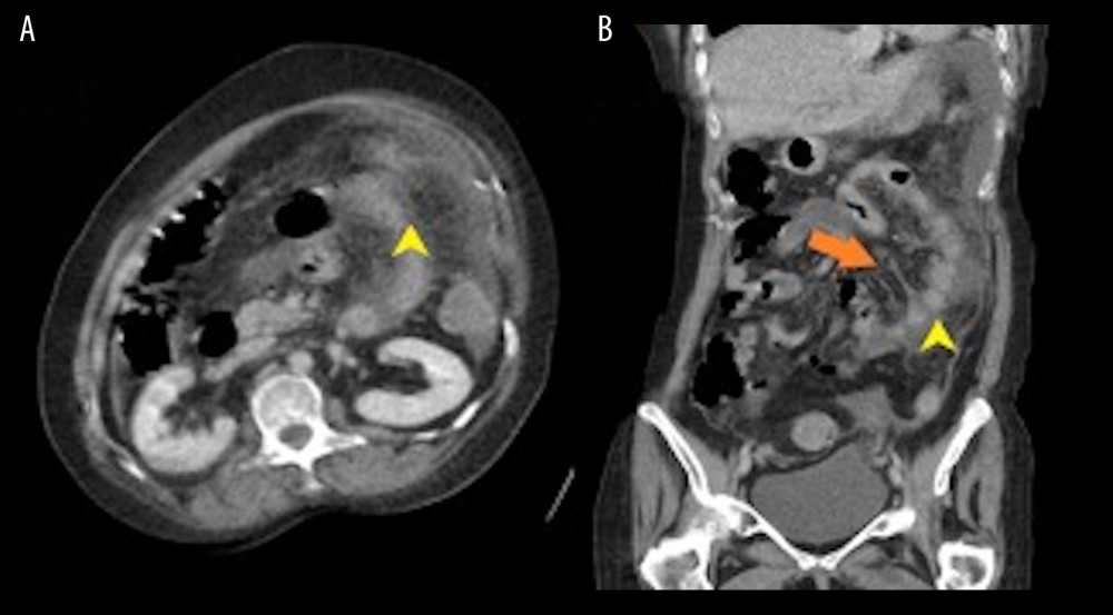 (A, B) Computed tomography of the abdomen with contrast. Notice the mild patchy thickening of the colon (yellow arrow) and slight soft-tissue thickening and nodularity of the omentum (orange arrow).