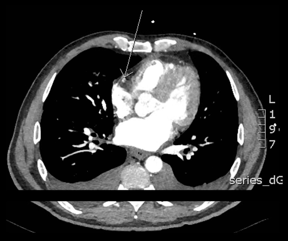 Computed tomography aortagram showing likely right coronary artery septic embolus.